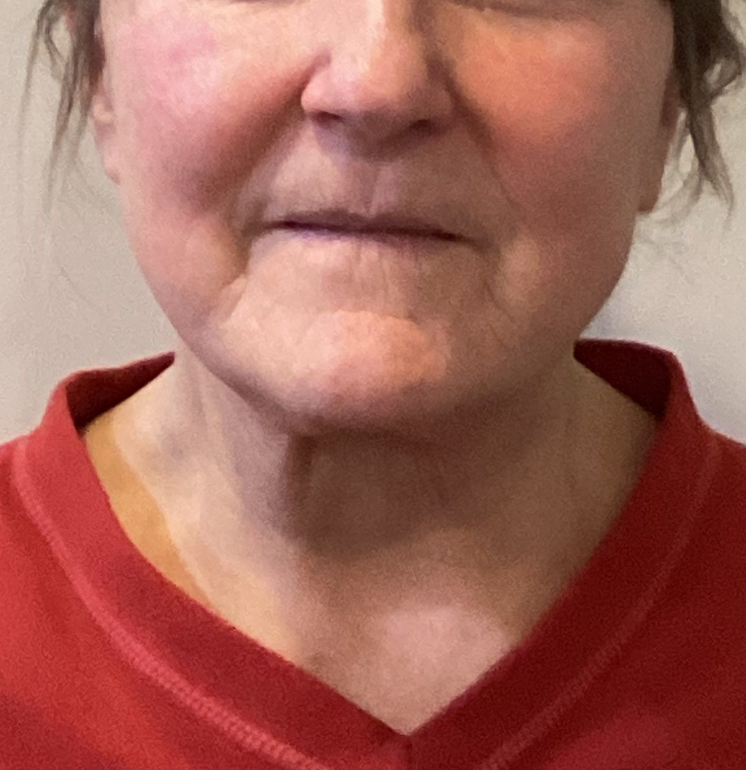 Facelift after