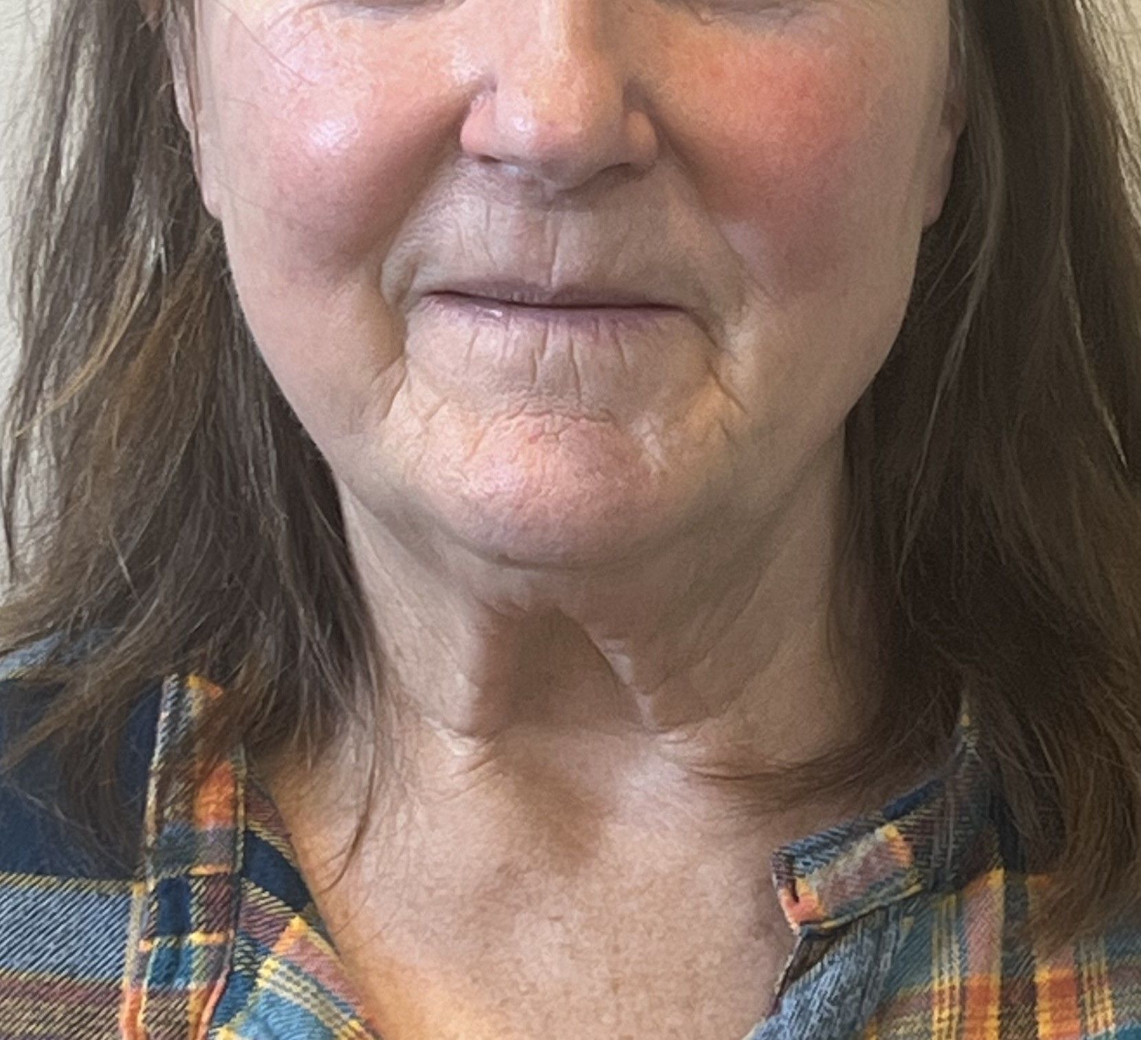 Facelift before