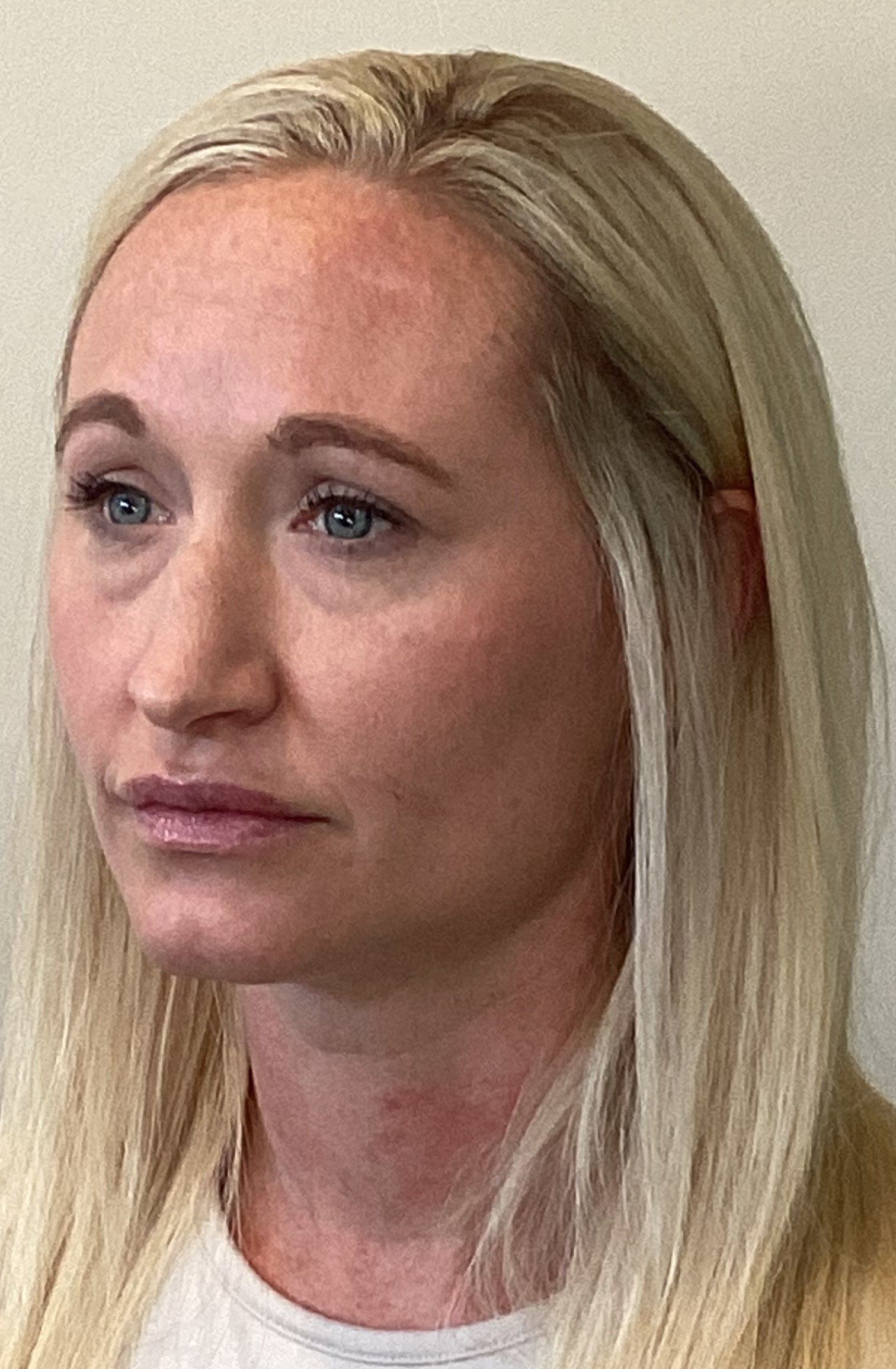 Rhinoplasty,  Lower Blepharoplasty, and Facial Fat Transfer before