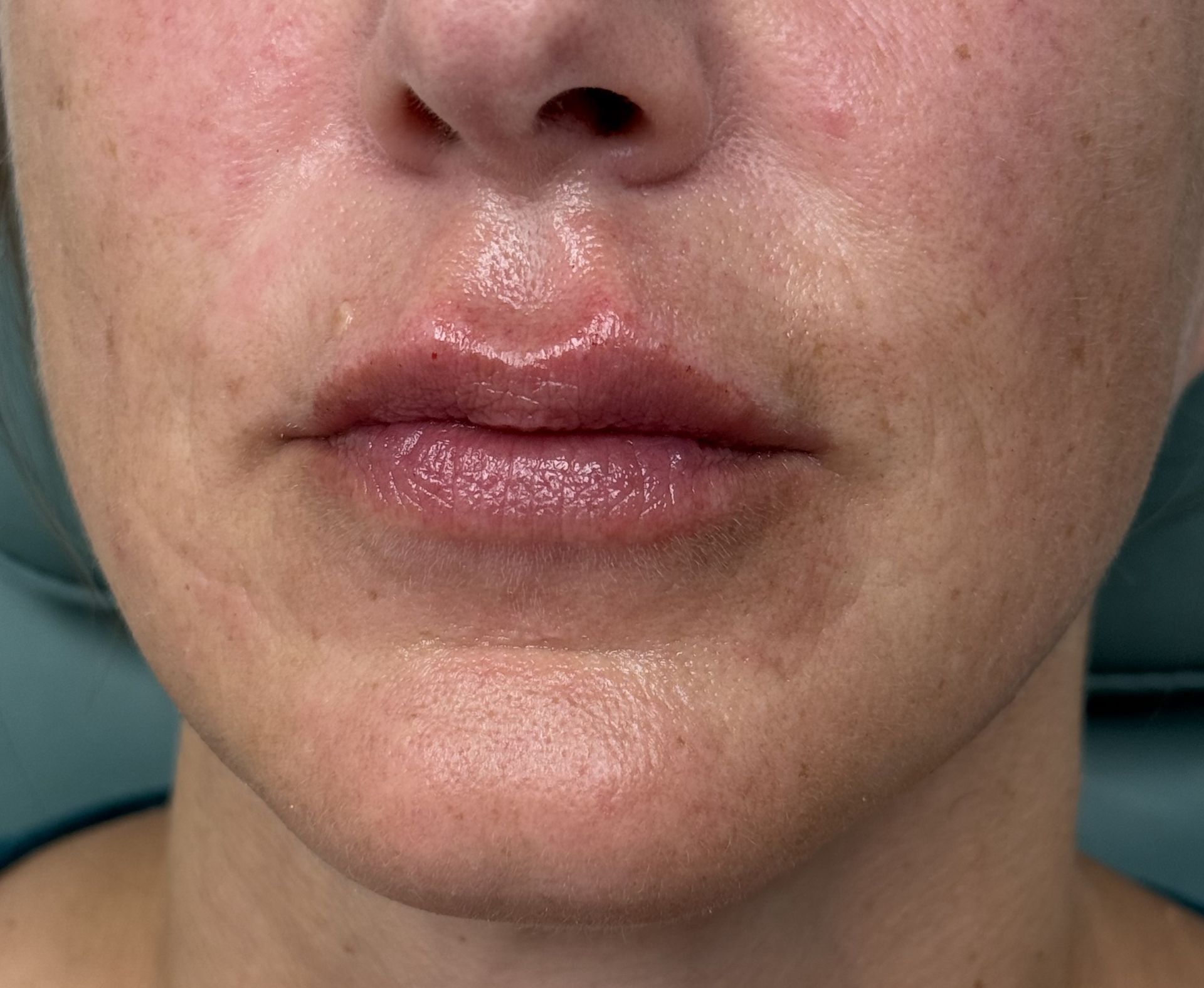 Lip Filler after