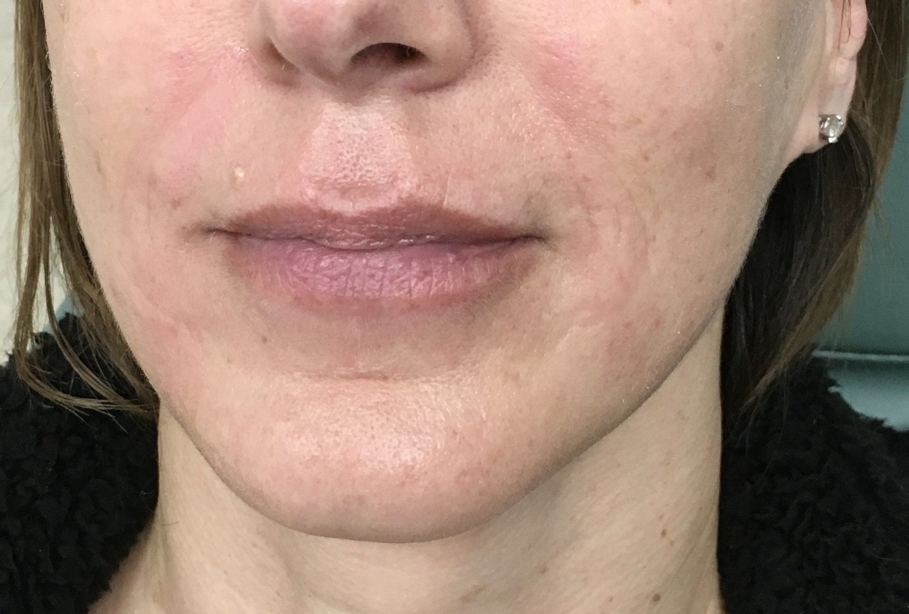 Lip Filler before