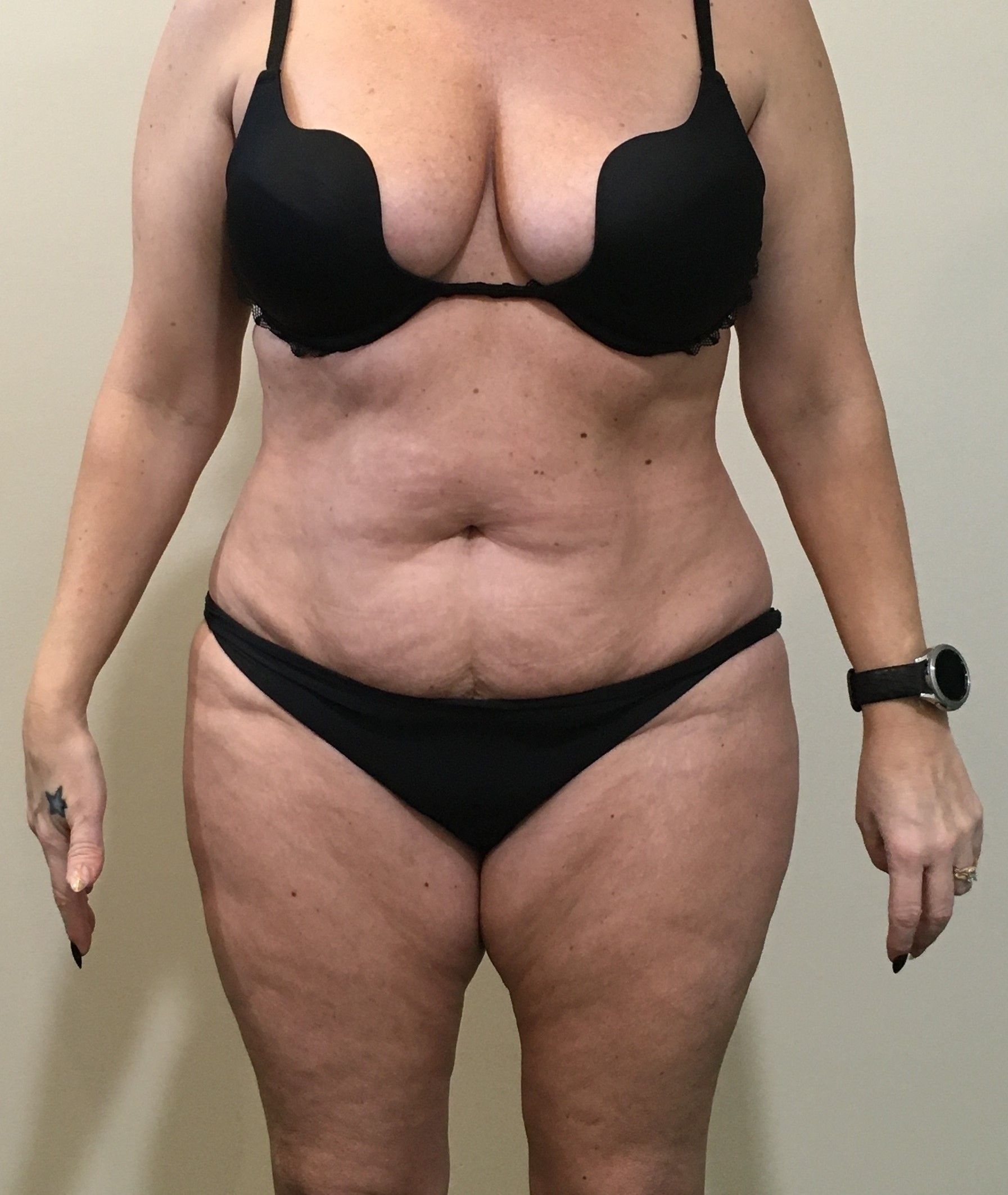Abdominoplasty (Tummy Tuck) with Liposuction to Hips before