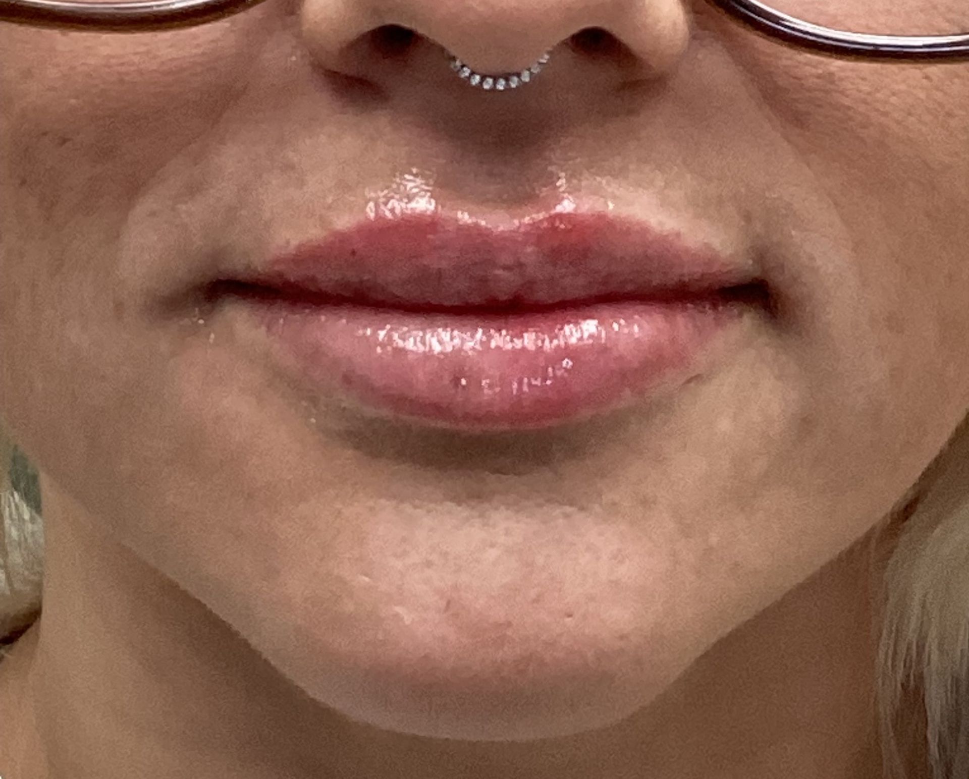 Lip Filler after
