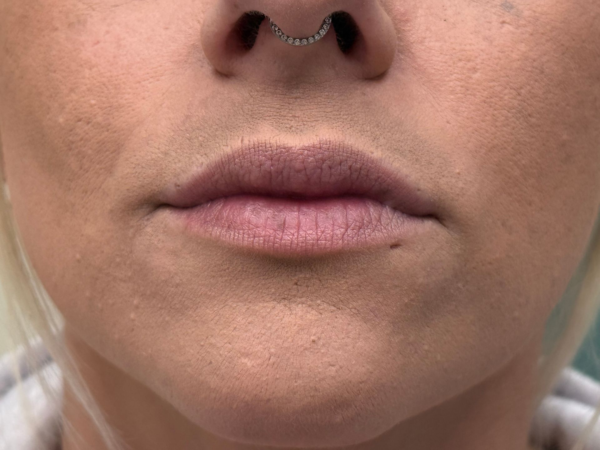 Lip Filler before