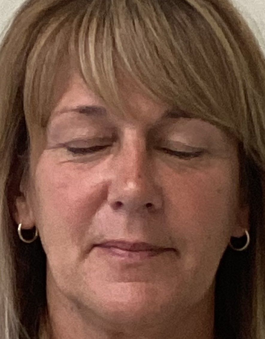 Rhinoplasty after