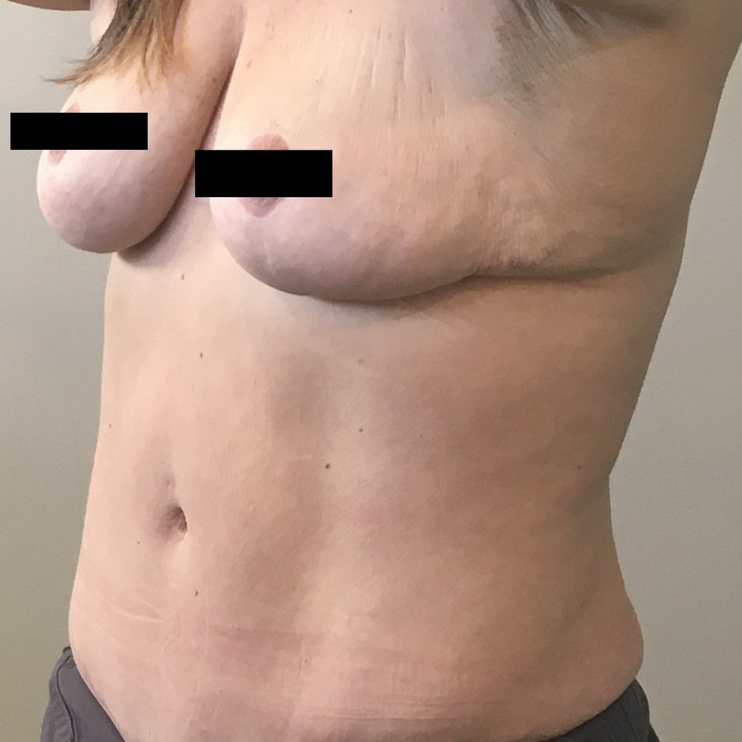 Liposuction before