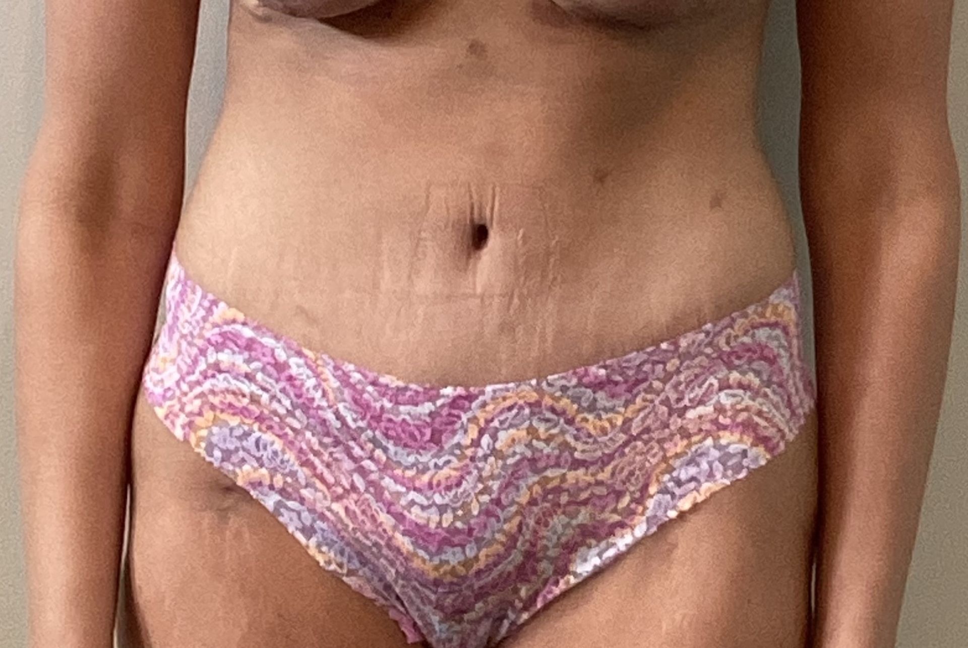 Abdominoplasty (Tummy Tuck) with Liposuction to Hips after