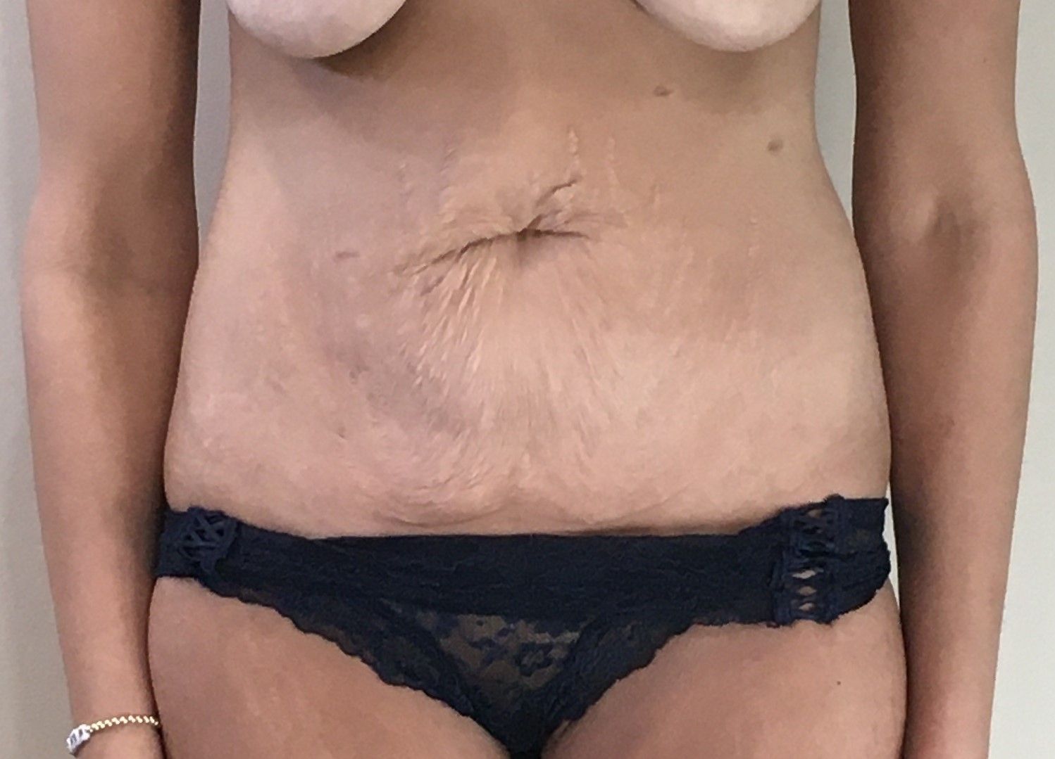 Abdominoplasty (Tummy Tuck) with Liposuction to Hips before