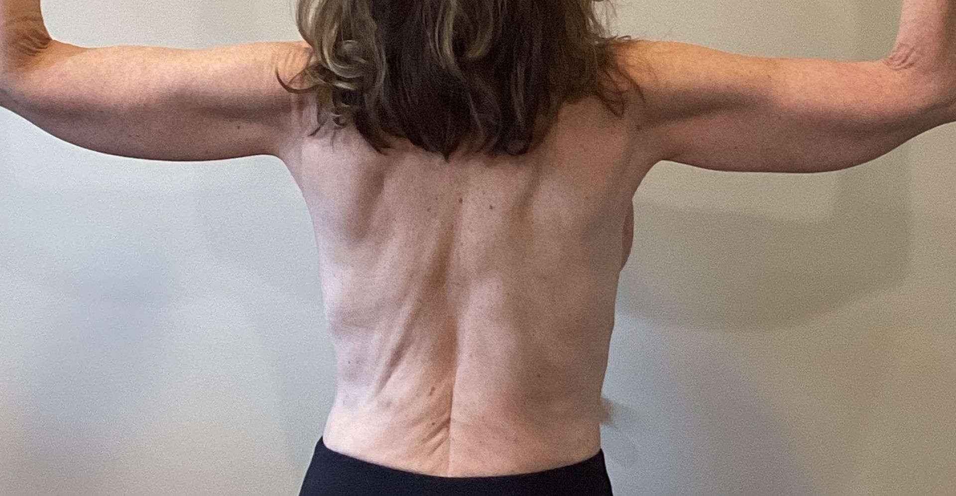 Brachioplasty (arm lift) after
