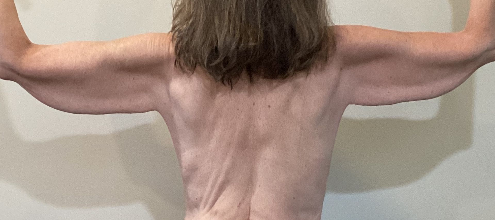 Brachioplasty (arm lift) before