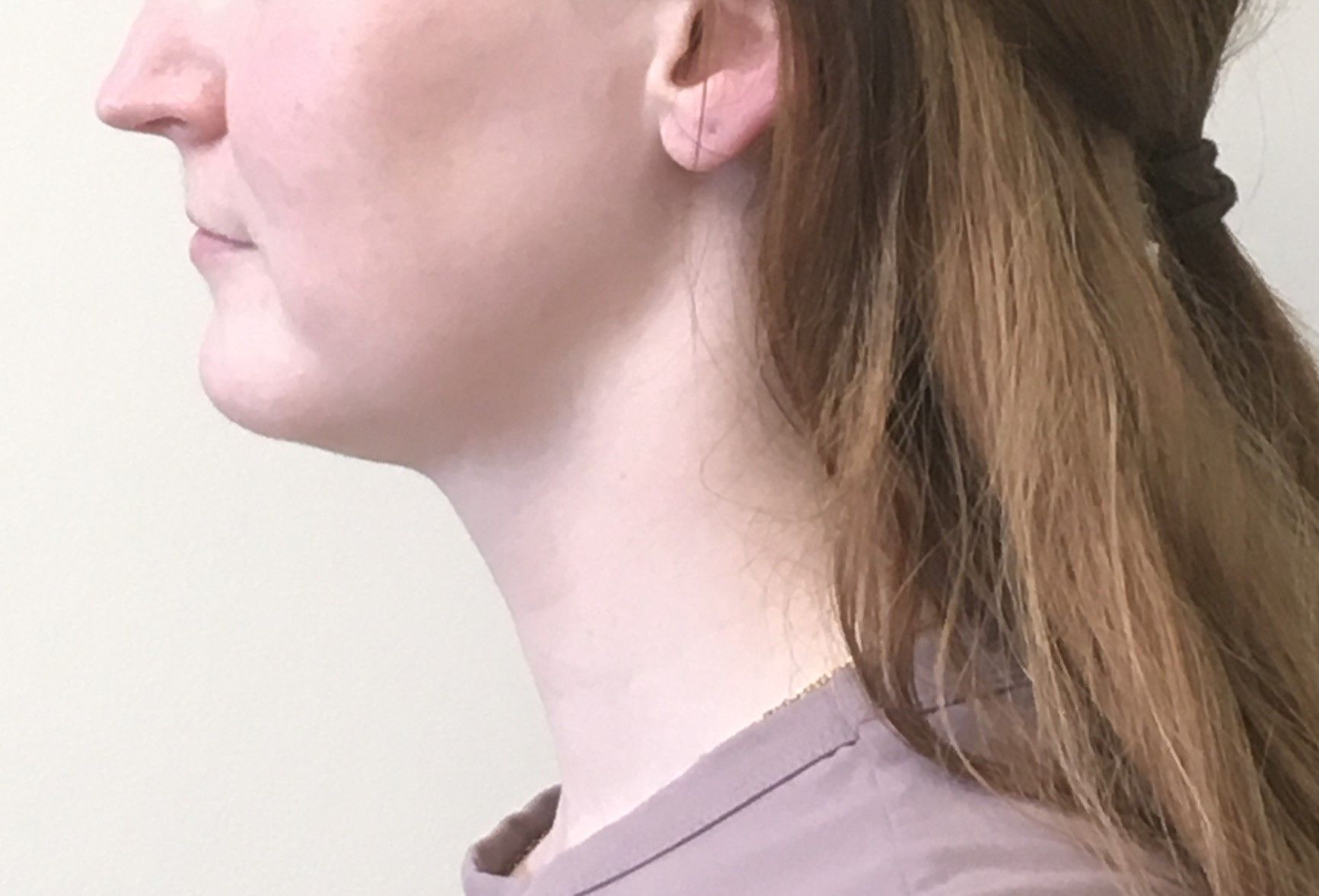 Awake Submental Liposuction after