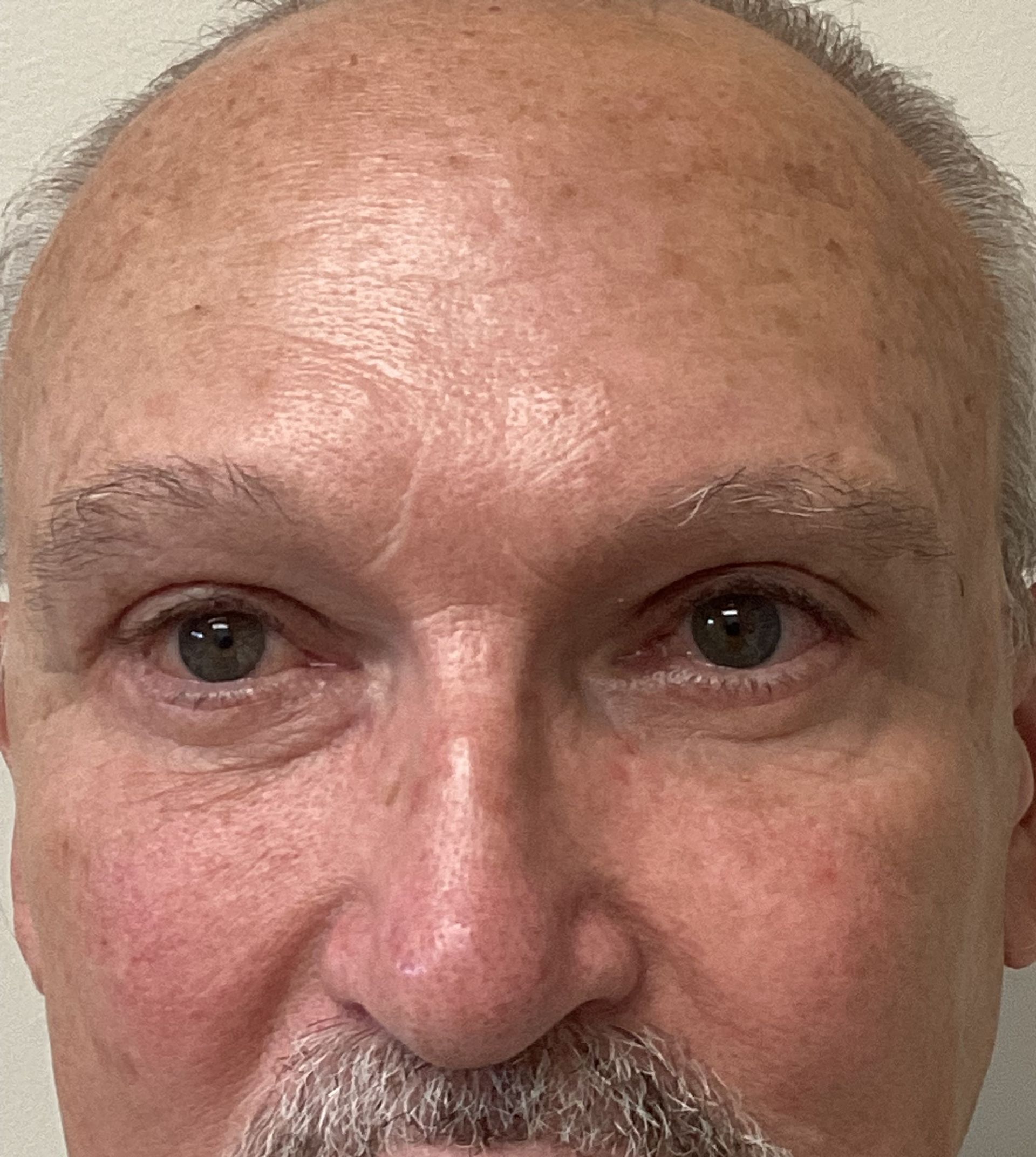 Facelift with Upper and Lower Blepharoplasty and Transbleph Browlift after
