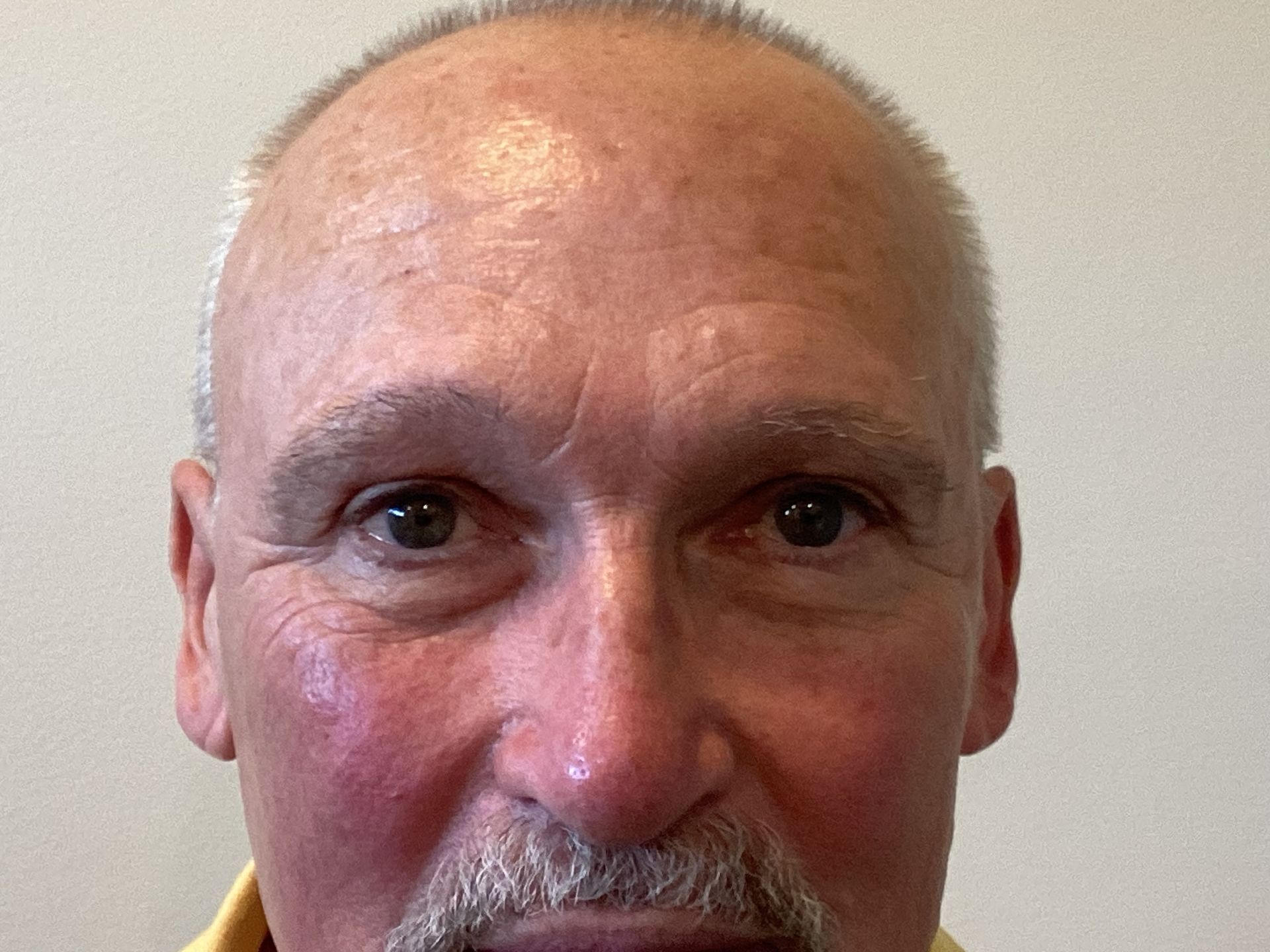 Facelift with Upper and Lower Blepharoplasty and Transbleph Browlift before