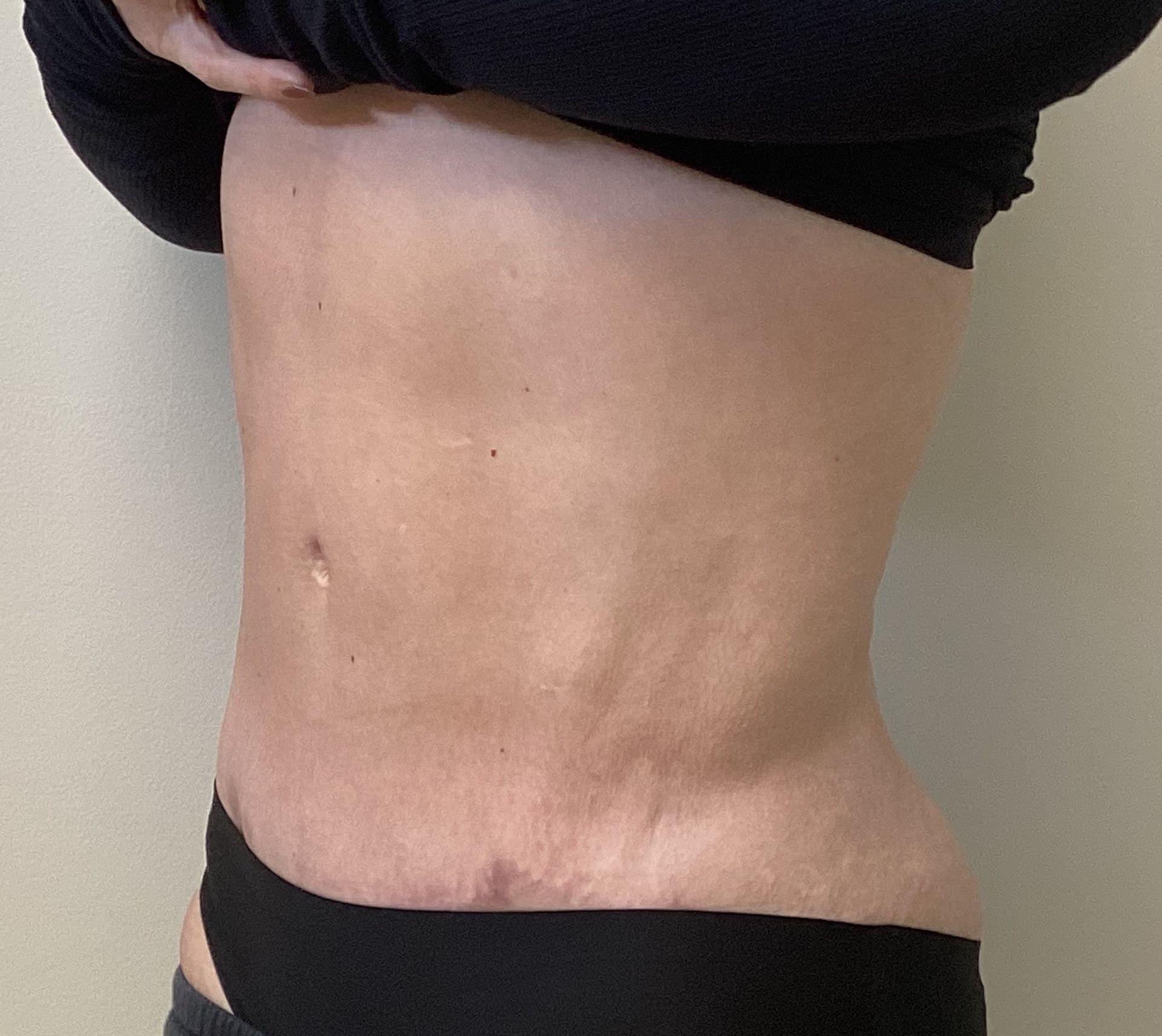 Liposuction after