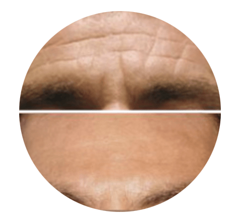 A before and after picture of a person 's forehead
