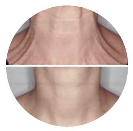 A before and after picture of a person 's neck