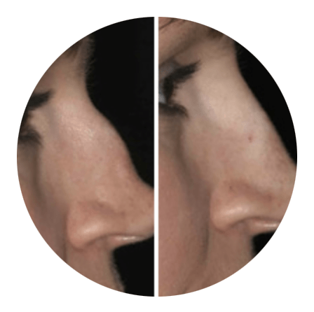 A before and after picture of a woman 's face