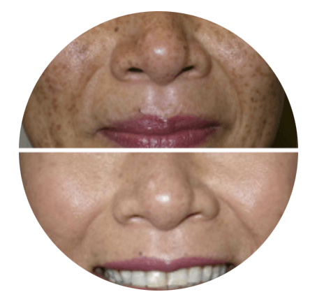 A before and after picture of a woman 's face