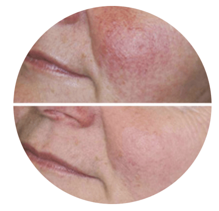A before and after photo of a woman 's face