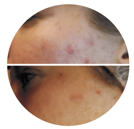 A before and after picture of a woman 's face with acne