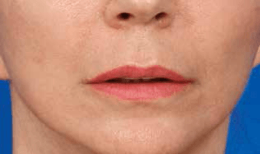 Above. Results from Lip Lift procedure – increasing youthful maxillary tooth display and lip volume