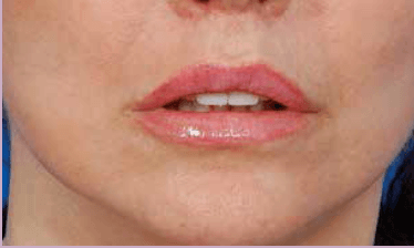 Above. Results from Lip Lift procedure – increasing youthful maxillary tooth display and lip volume