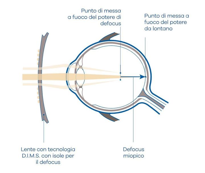 Schema del funzionamento dell'occhio e della lente degli occhiali, che mostra la luce che entra e converge sulla retina.