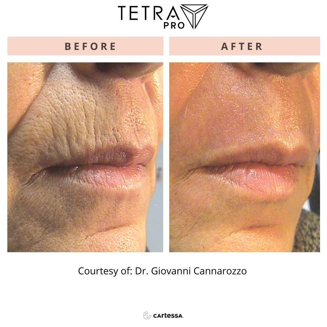 Before-and-after close-up of lips.