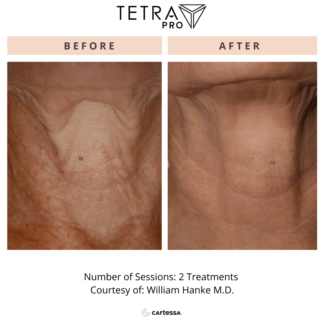 Before-and-after skin treatment comparison showing reduced neck wrinkles.
