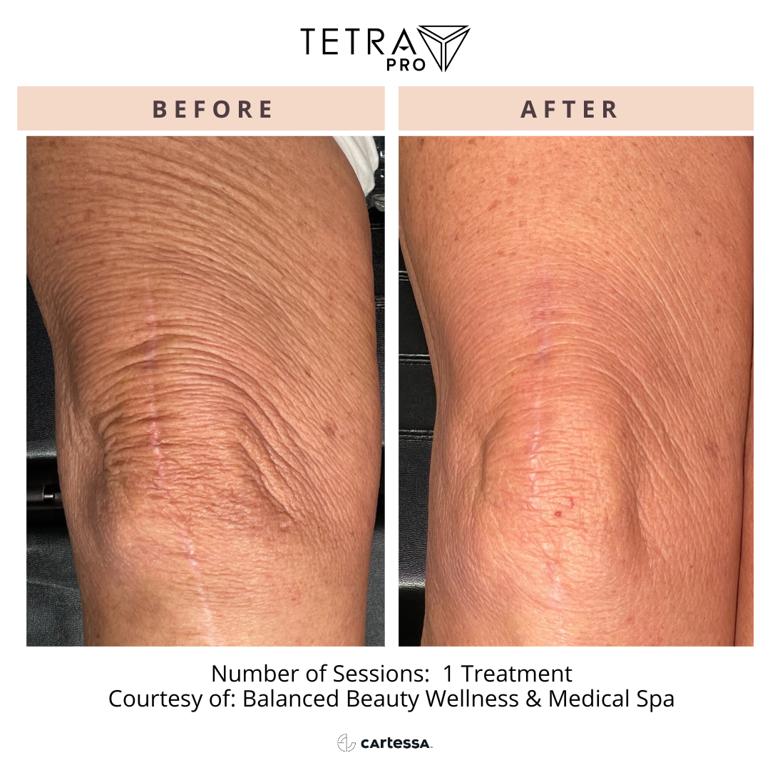 Before-and-after close-up of a knee, showing reduced wrinkles and smoother skin after treatment