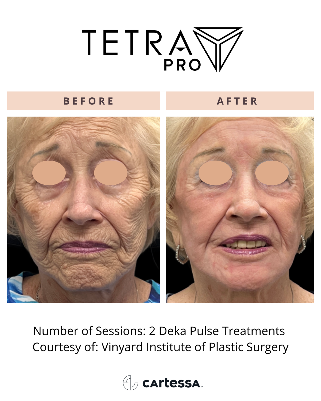 Before-and-after facial treatment results showing smoother skin, under-eye area, and wrinkles reduced.
