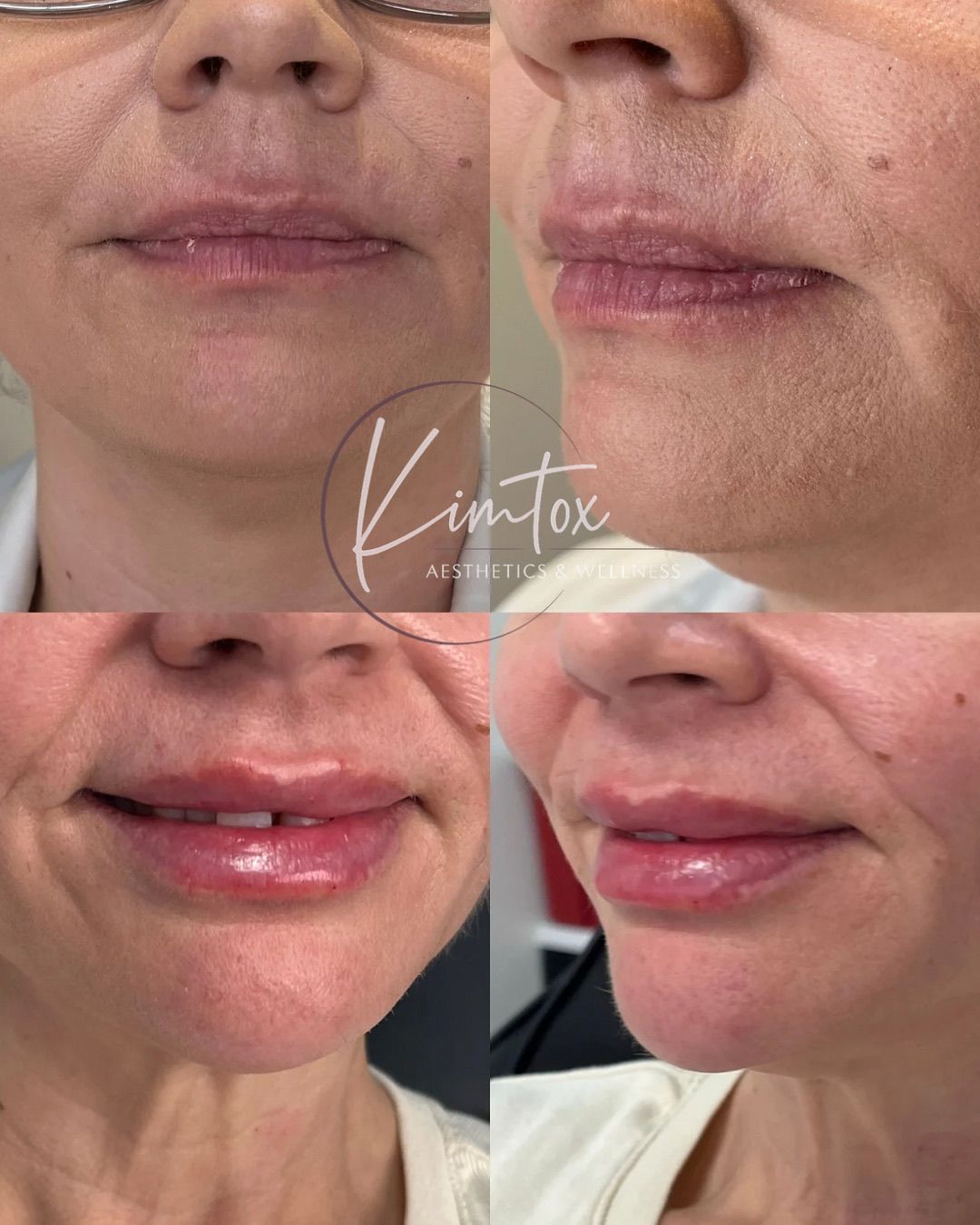 Before-and-after collage of lips and lower face, showing fuller, smoother lips after treatment