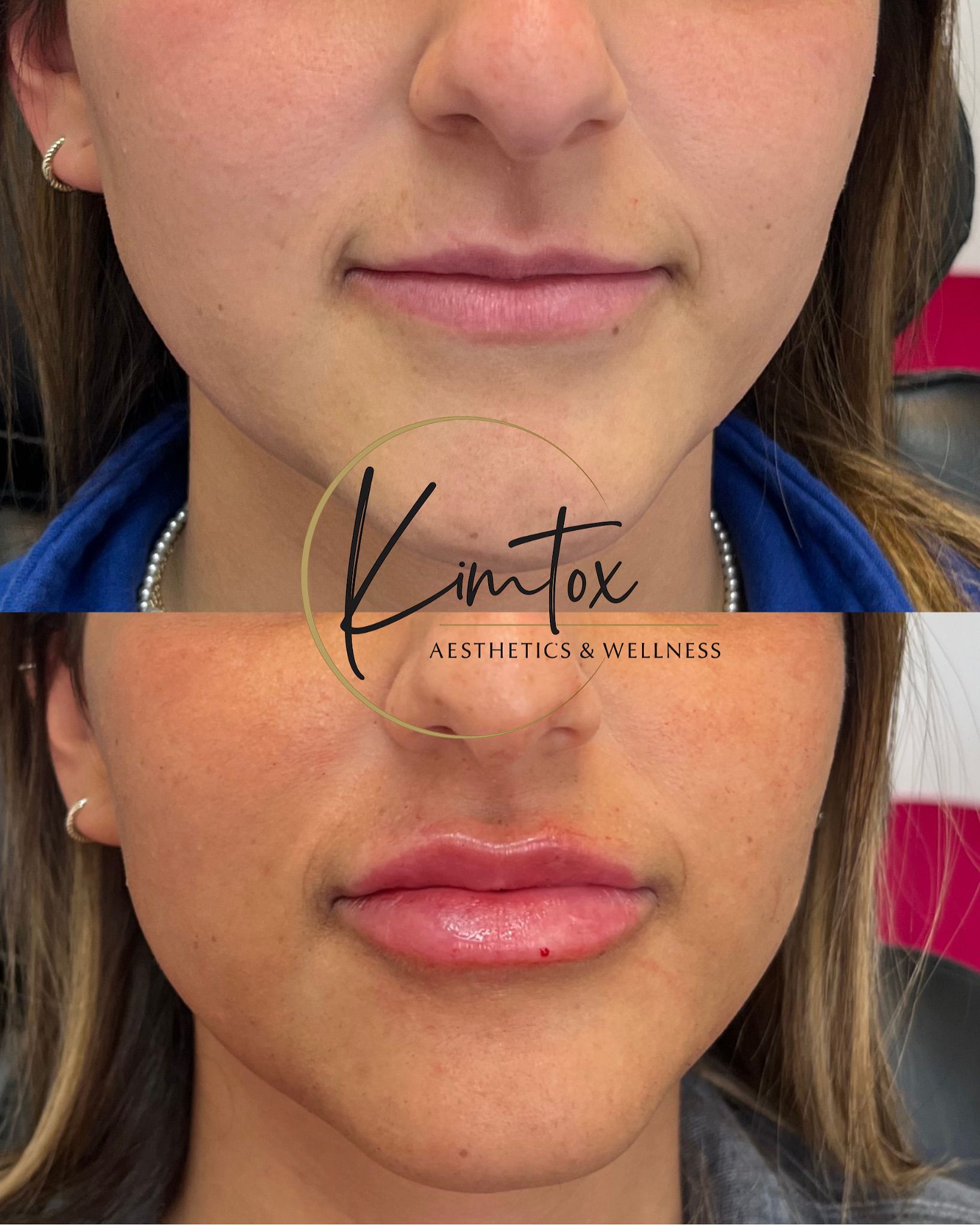 Before-and-after close-up of a person’s lips.
