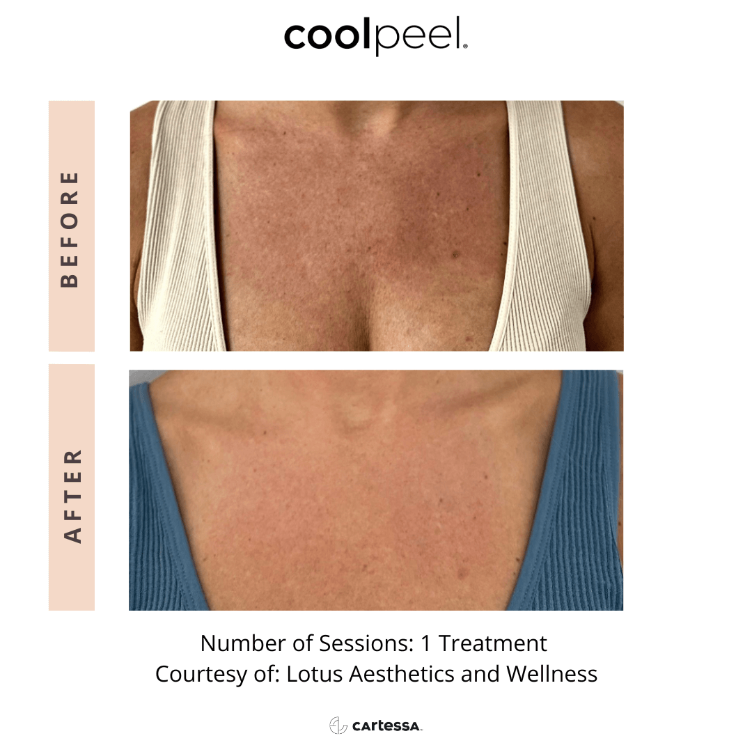 Before-and-after CoolPeel treatment on chest skin, showing reduced redness and smoother tone.