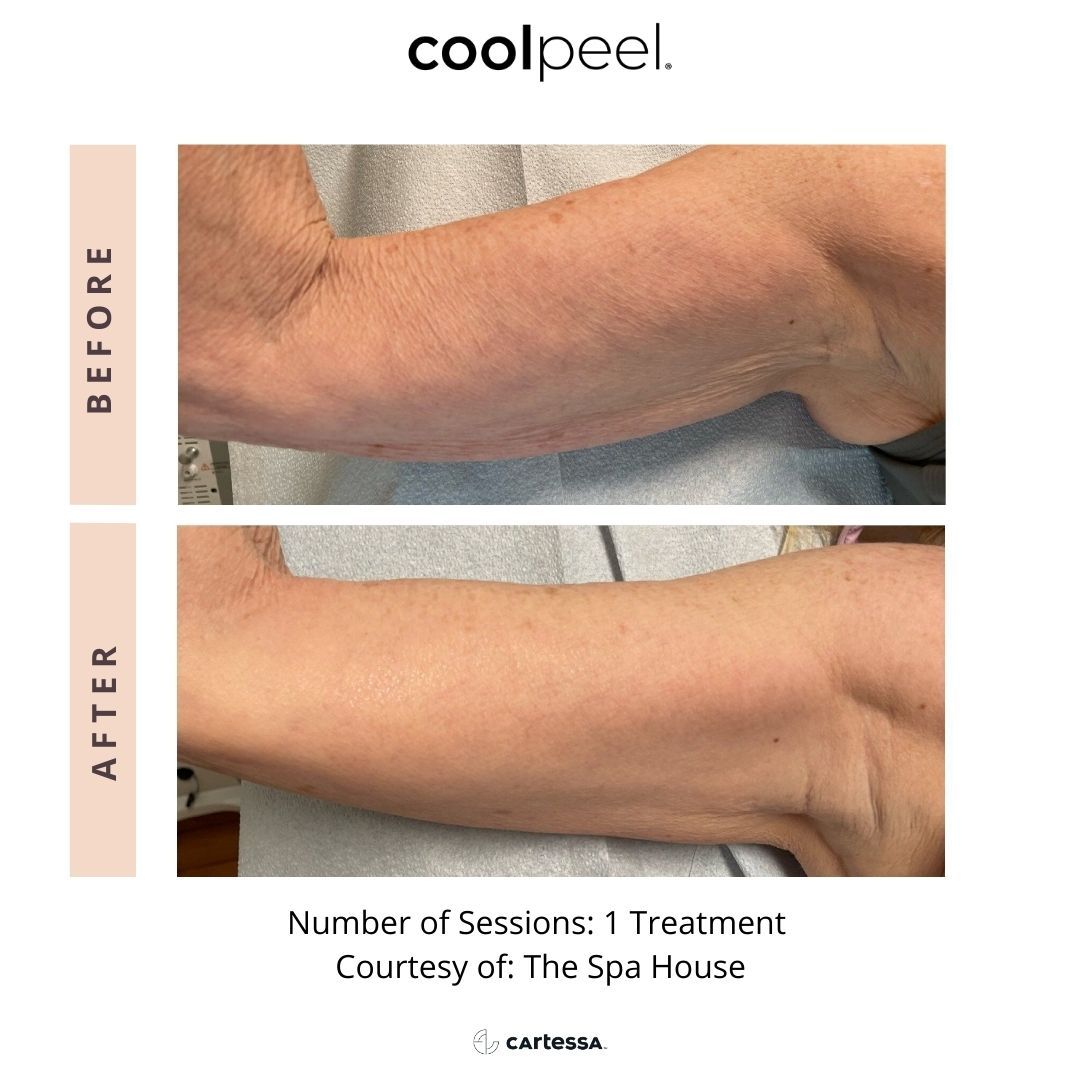 Before-and-after close-up of an arm showing smoother skin after CoolPeel treatment.