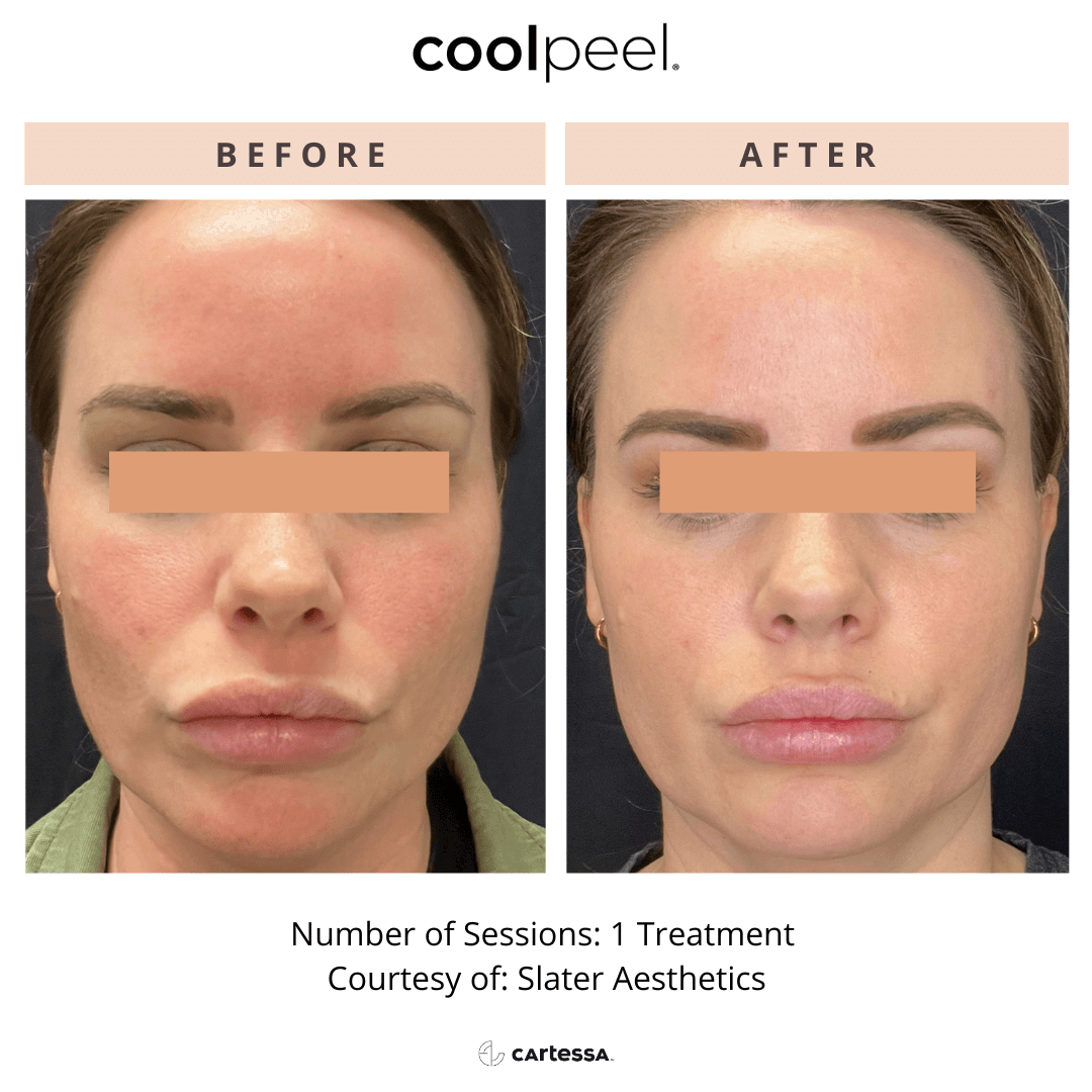 Before-and-after facial treatment photo showing reduced redness and smoother skin.