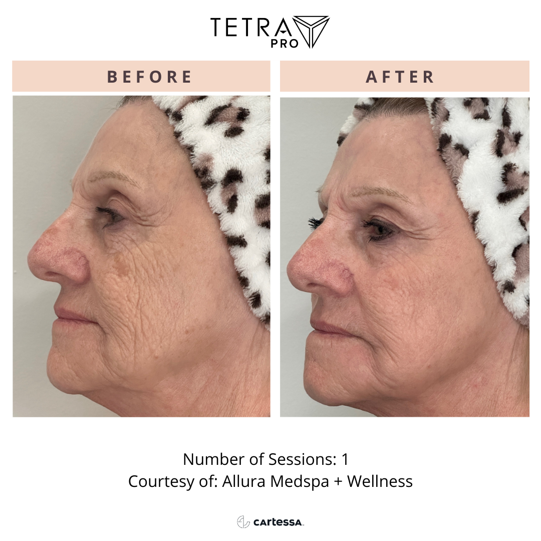 Before-and-after side profile of a woman’s face after treatment, showing reduced wrinkles.