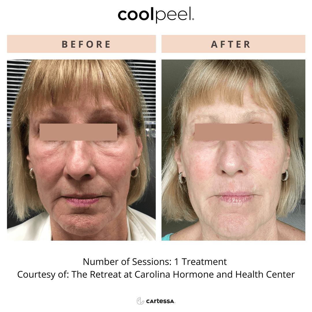 Before-and-after cosmetic treatment photos of a woman, showing lighter skin and smoother appearance after .