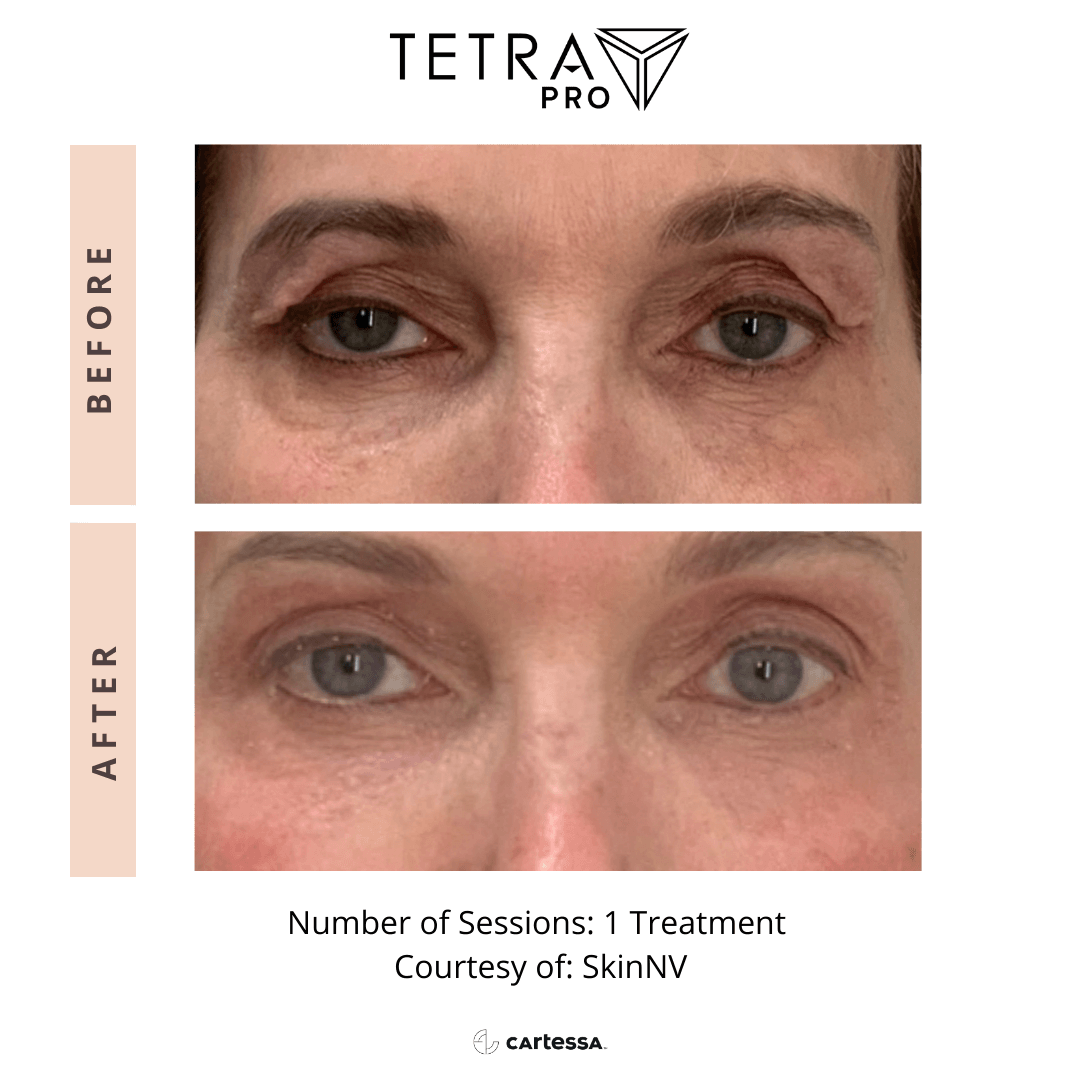 Before-and-after close-up of eyes showing reduced under-eye wrinkles.