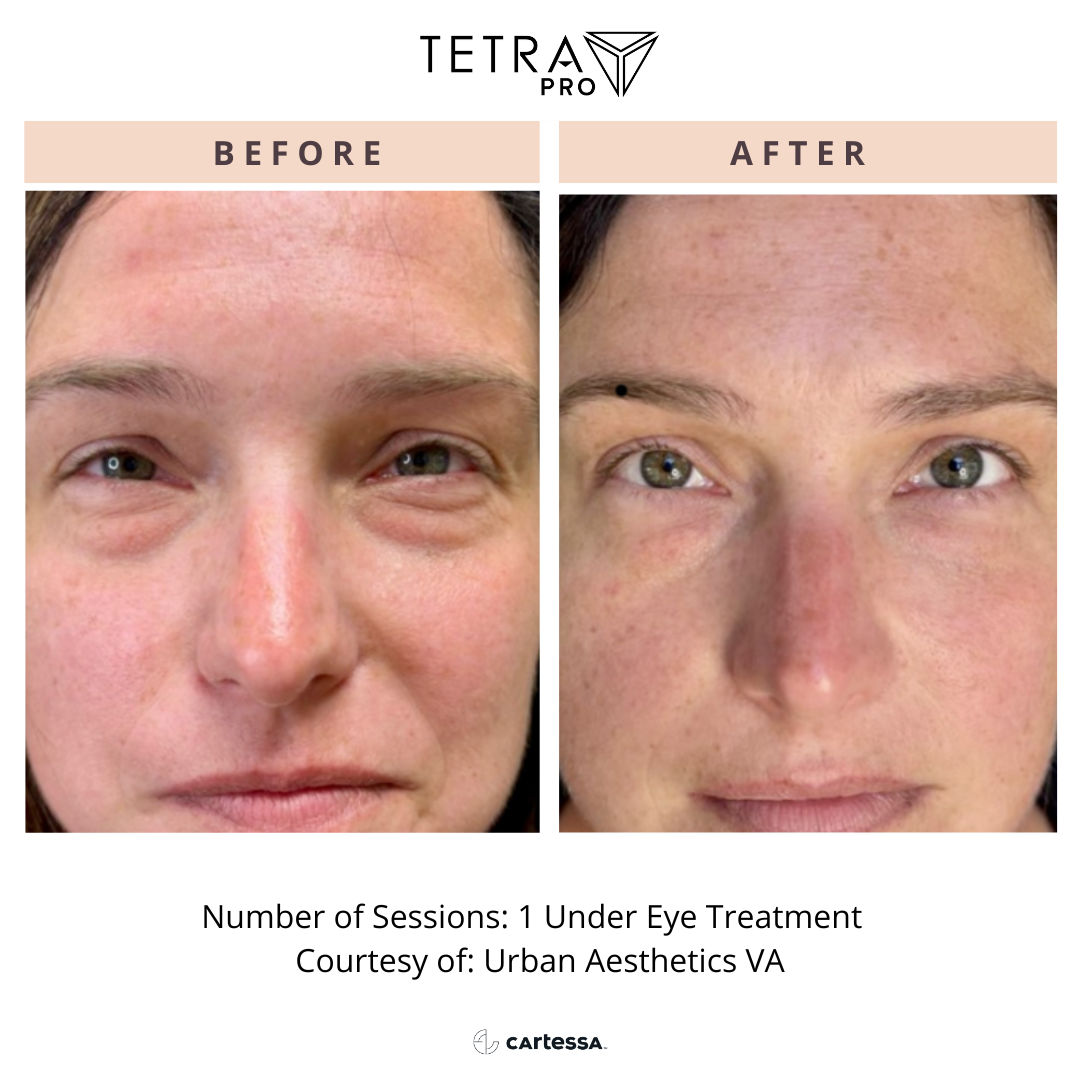 Before-and-after under-eye treatment comparison showing reduced puffiness and discoloration.