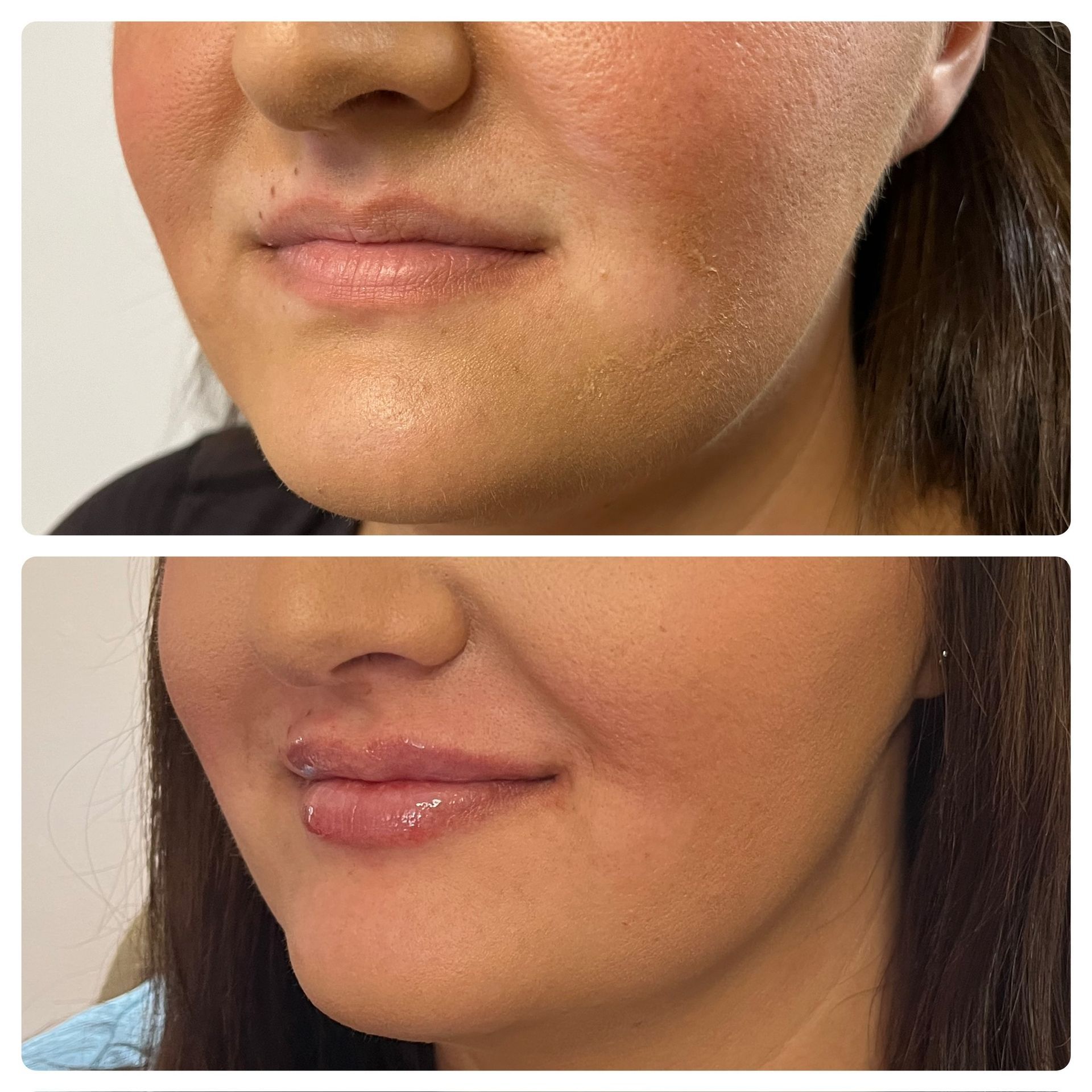 Before and after close-up of a woman's lower face, showing smoother skin and glossier lips in the bottom image