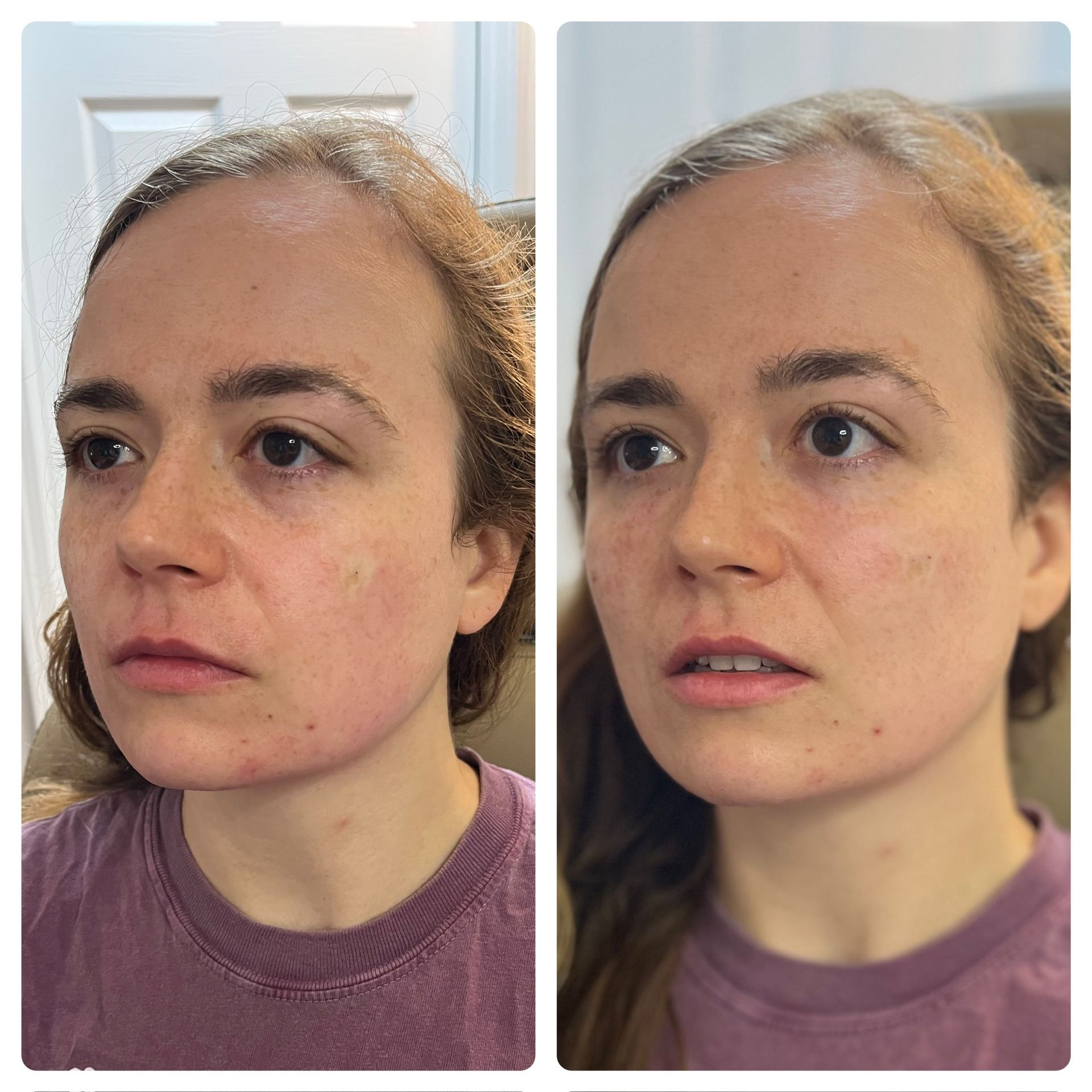 Two side-by-side before-and-after profile photos of a person in a purple shirt, looking left with a neutral expression.
