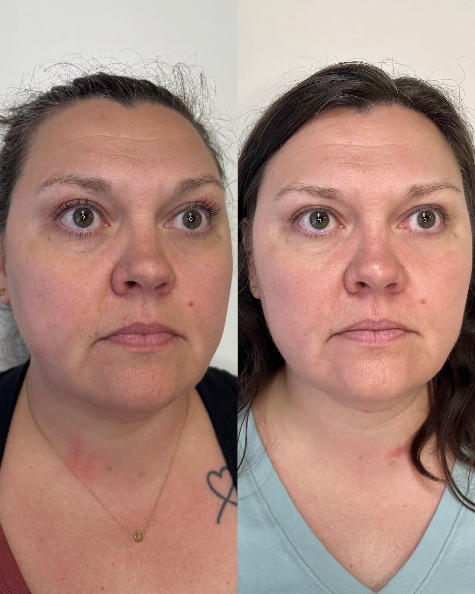 Side-by-side facial close-up of a woman before and after with smoother skin on the right.