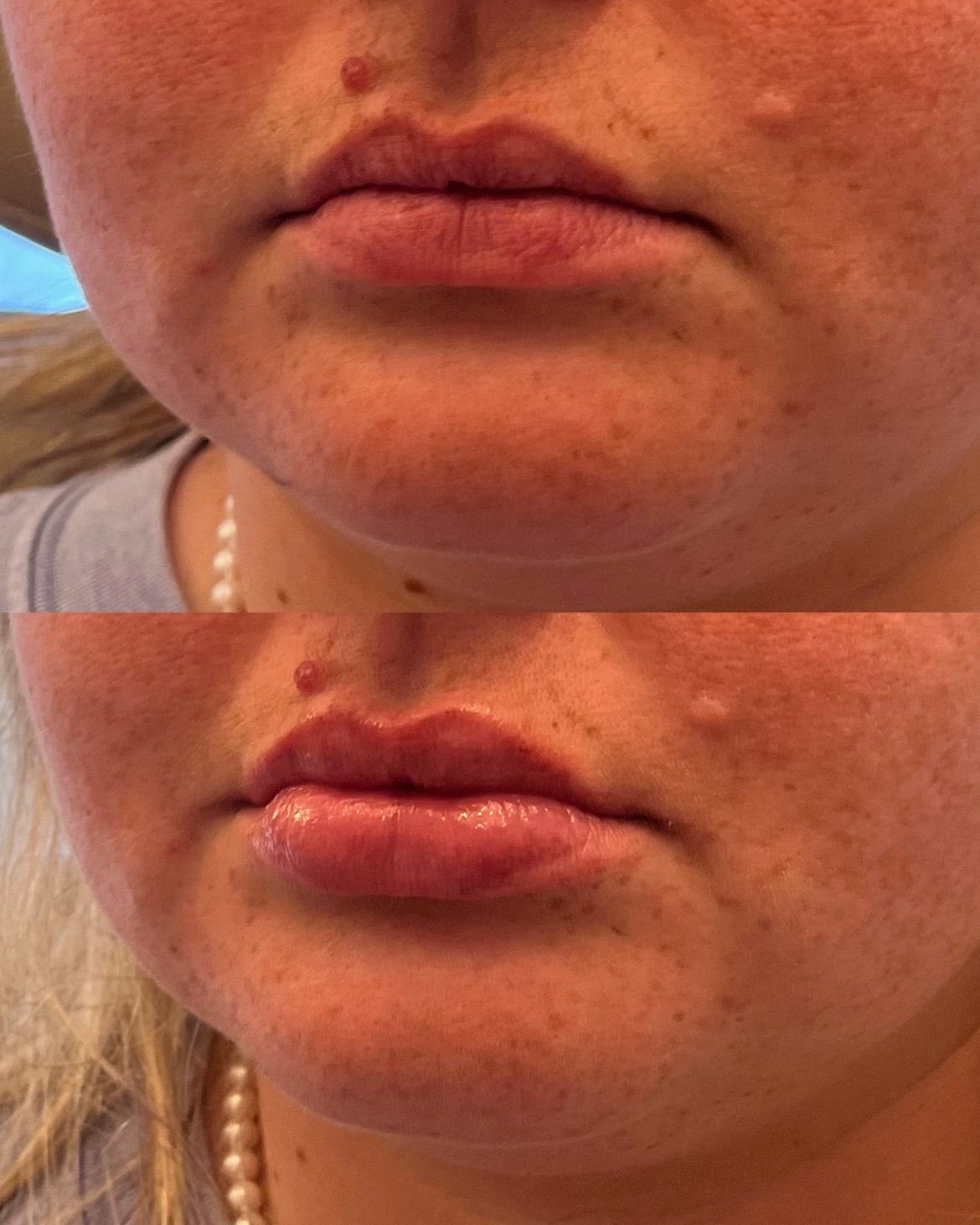 Close-up of a person’s mouth and chin with dry, irritated skin around the lips.