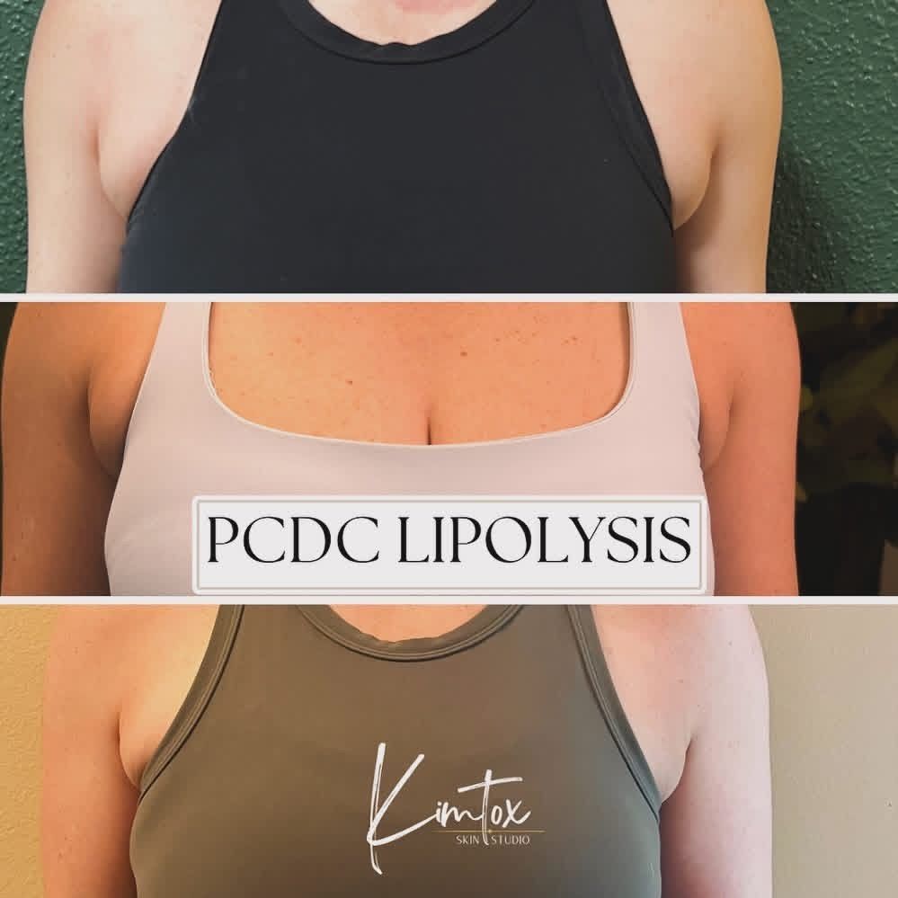 Three-panel torso comparison showing different tops and labels for PCDC lipolysis and Kimtox treatments.