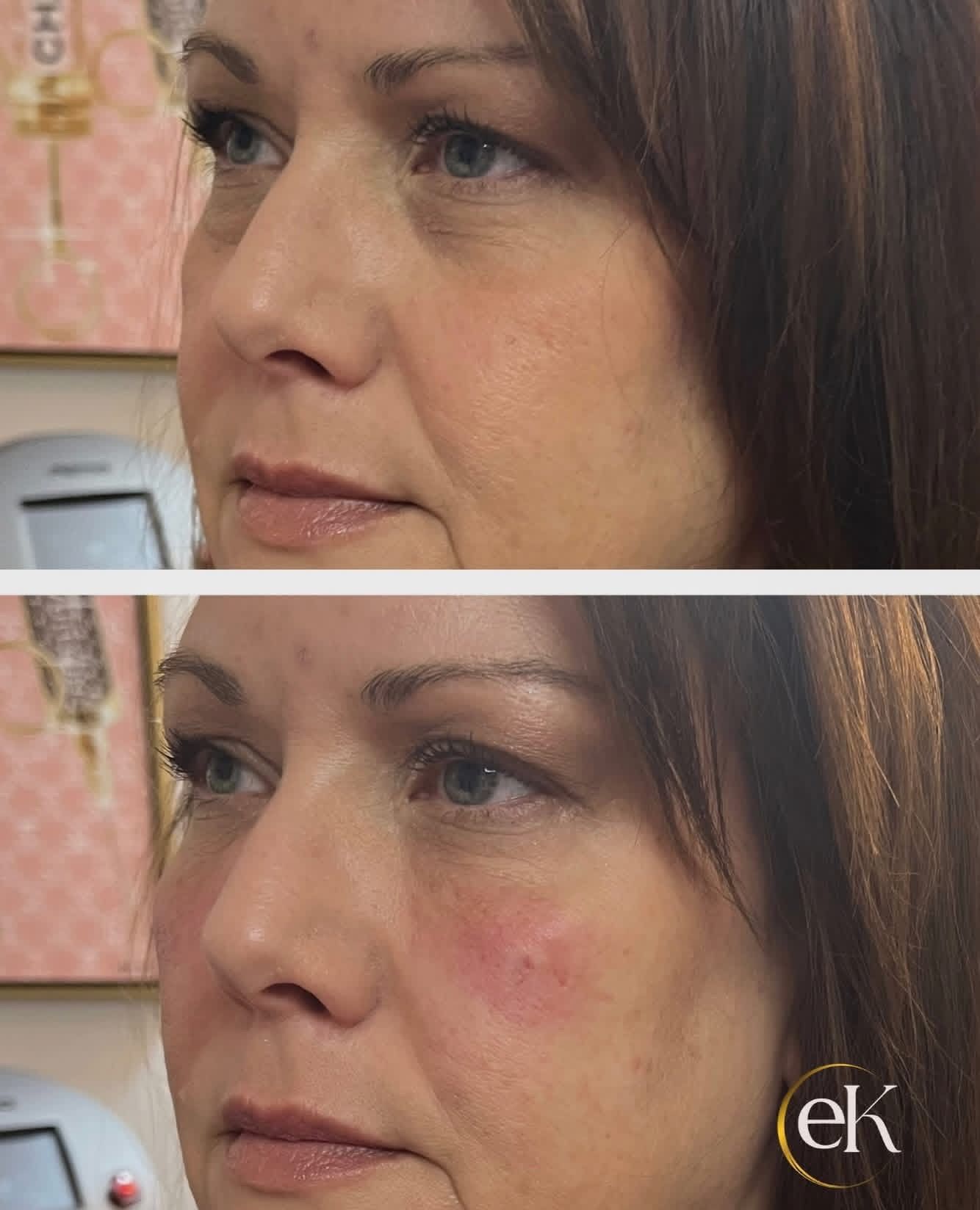 Side-by-side close-up of a woman’s cheek, showing a red rash before and after treatment.