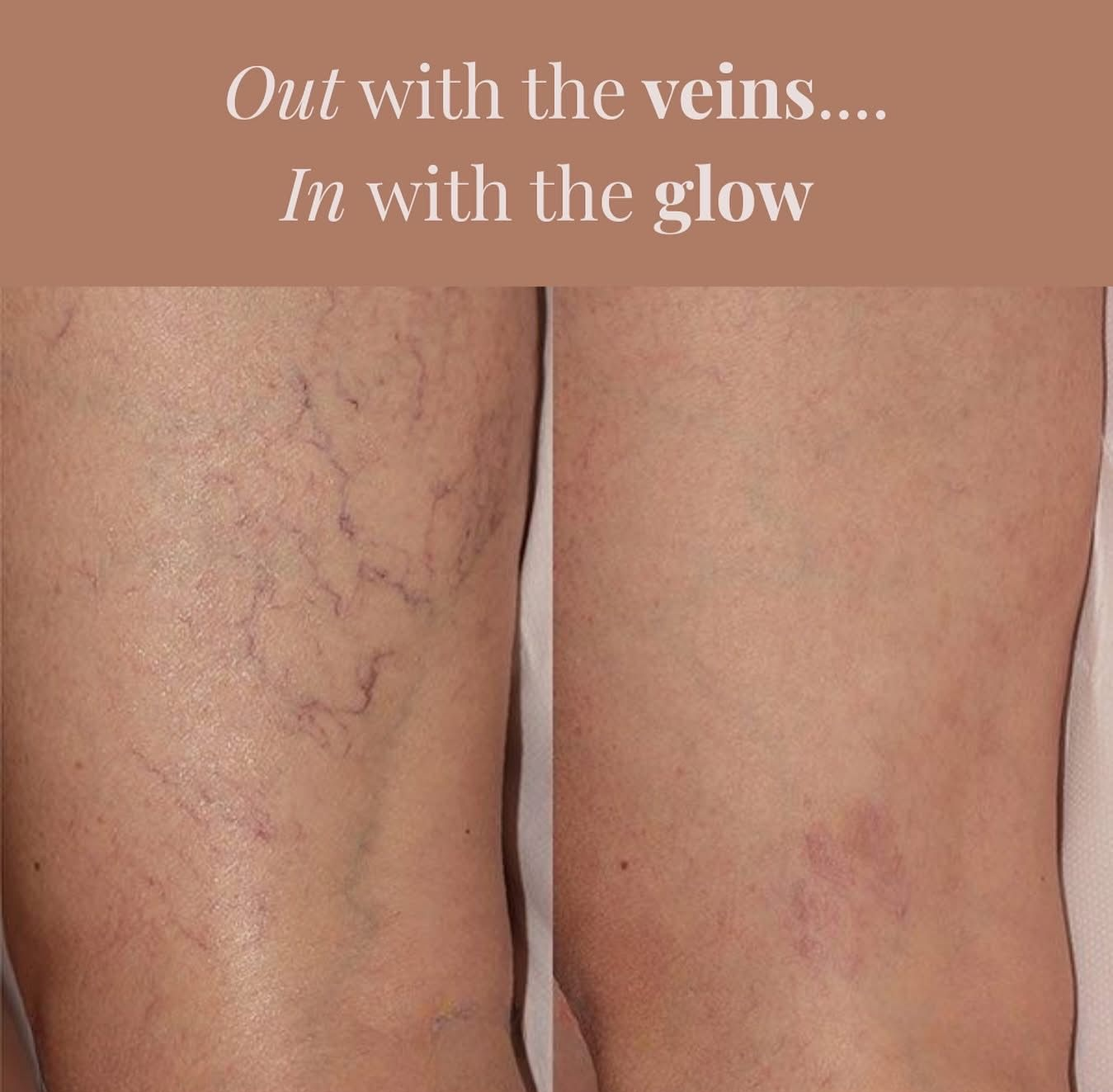 Before-and-after close-up of legs with visible veins on left and smoother skin on right, with caption text above.