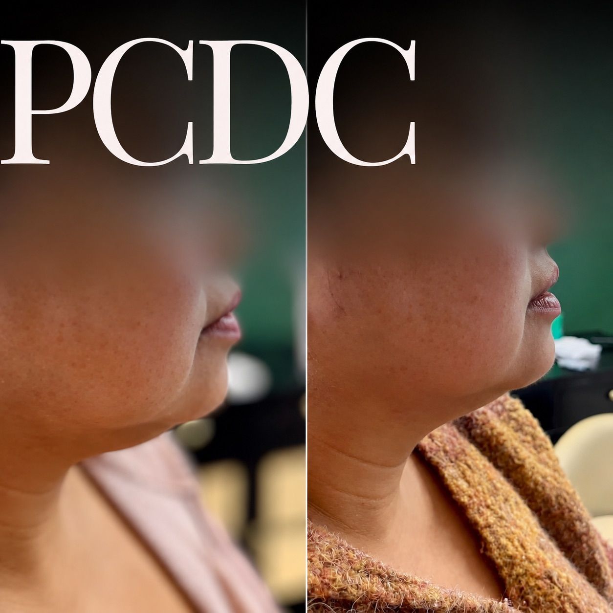 Side-by-side profile photos of a person’s chin and jawline before and after treatment