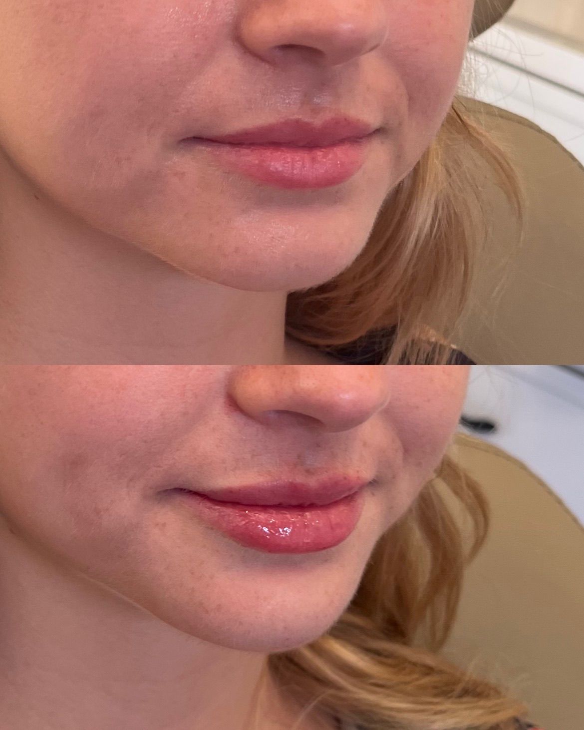 Close-up of a smiling person’s lower face,  before and after.