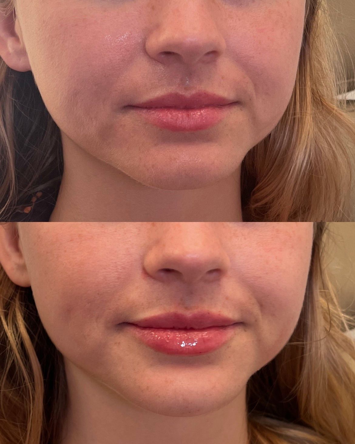 Side-by-side close-up of the lower face, showing lips before and after.